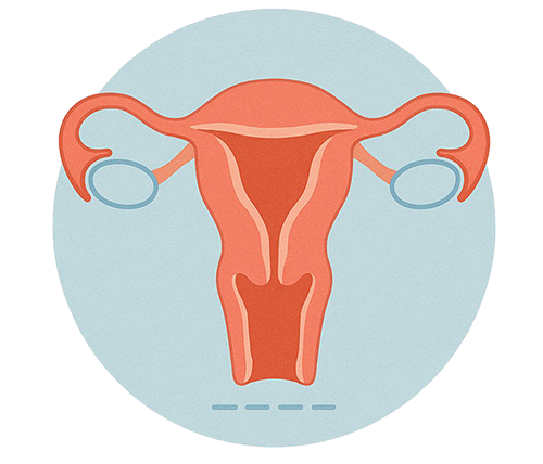 illustration of open hysterectomy
