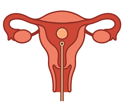 Illustration of HYSTEROSCOPIC RESECTION OF FIBROID