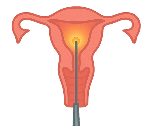 illustration of endometrial ablation