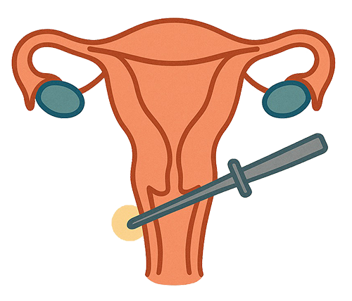 Illustration of HYSTEROSCOPY AND BIOPSY