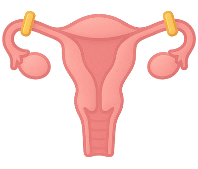 Illustration of LAPAROSCOPIC STERILISATION